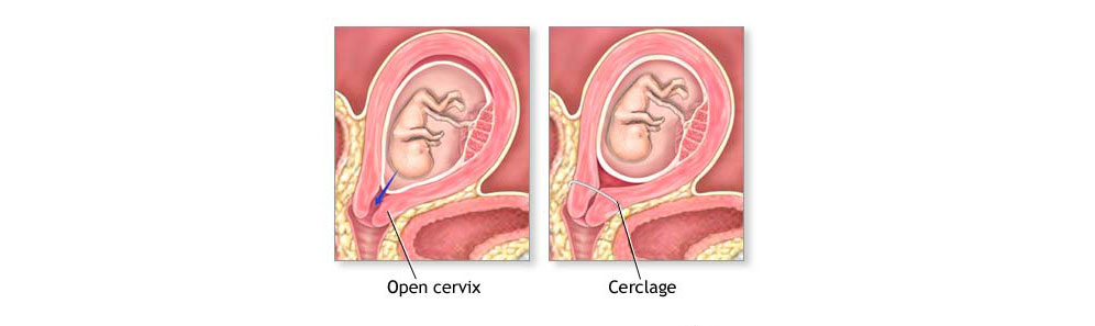 Cervical cerclage care act Cervical cerclage care act