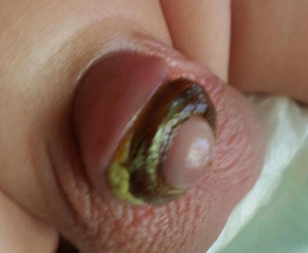 مراقبت های قبل و بعد از عمل جراحی ختنه نوزاد