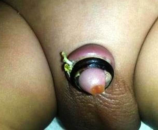 مراقبت های قبل و بعد از عمل جراحی ختنه نوزاد