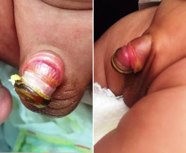 مراقبت های قبل و بعد از عمل جراحی ختنه نوزاد