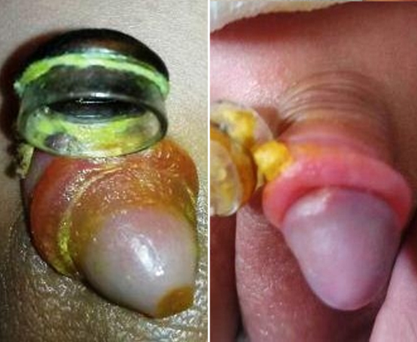 مراقبت های قبل و بعد از عمل جراحی ختنه نوزاد