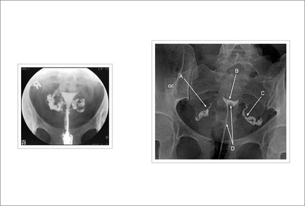 هيستروسالپنگوگرام