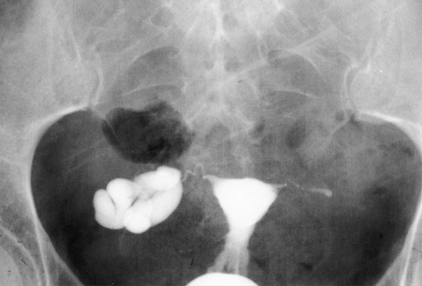 هيستروسالپنگوگرام