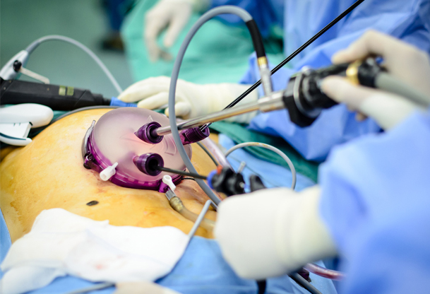 لاپاراسکوپی رحم