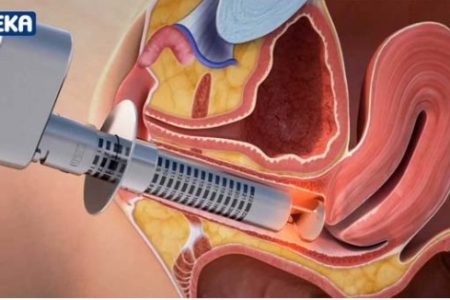 لاپاراسکوپی رحم