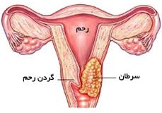 سرطان رحم